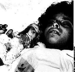 Poison gas victim, Halabjah 1988